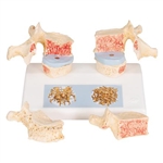 3B Scientific Osteoporosis Didactic Model Smart Anatomy