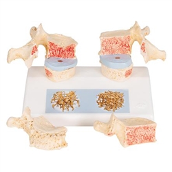 3B Scientific Osteoporosis Didactic Model Smart Anatomy