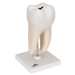 3B Scientific Lower Twin-Root Molar with Cavities Human Tooth Model, 2 Part Smart Anatomy