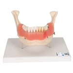 3B Scientific Dental Disease Model, Magnified 2 Times, 21 Parts Smart Anatomy