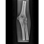 ERLER ZIMMER X-ray Phantom Elbow (Opaque)