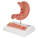 3B Scientific Human Stomach Section Model with Ulcers Smart Anatomy