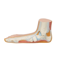 3B Scientific Flat Foot (Pes Planus) Model Smart Anatomy