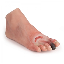 Erler Zimmer Wound Foot with Diabetic Foot Syndrome