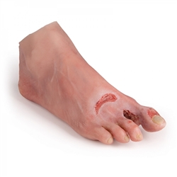 Erler Zimmer Wound Foot with Diabetic Foot Syndrome, Severe Stage
