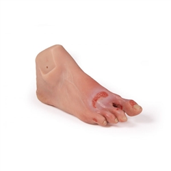Erler Zimmer Wound Foot with Diabetic Foot Syndrome, Severe Stage, Manikin Version