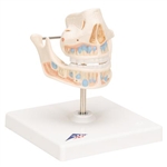 3B Scientific Milk Denture Model with Remaining Teeth Smart Anatomy