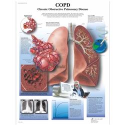 3B Scientific COPD Chart, Chronic Obstructive Pulmonary Disease