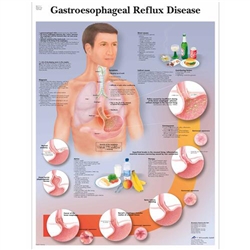 3B Scientific Gastroesophageal Reflux Disease Chart