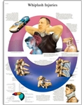 Acceleration Injury to the Cervical Spine Chart