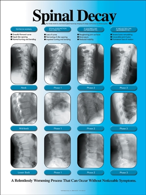 Spinal Decay X-ray Chart