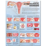 Common Gynecological Disorders Anatomical Chart (Laminated)