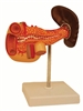 Diseased Pancreas with Duodenum and Spleen Model