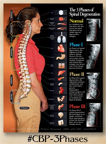 Celebration Poster Gift Offer <br><strong>3 Phase of Spinal Degeneration 22 x 28 (non-laminated)</strong><BR>For Licensed DC Only - One Per Doctor/Clinic